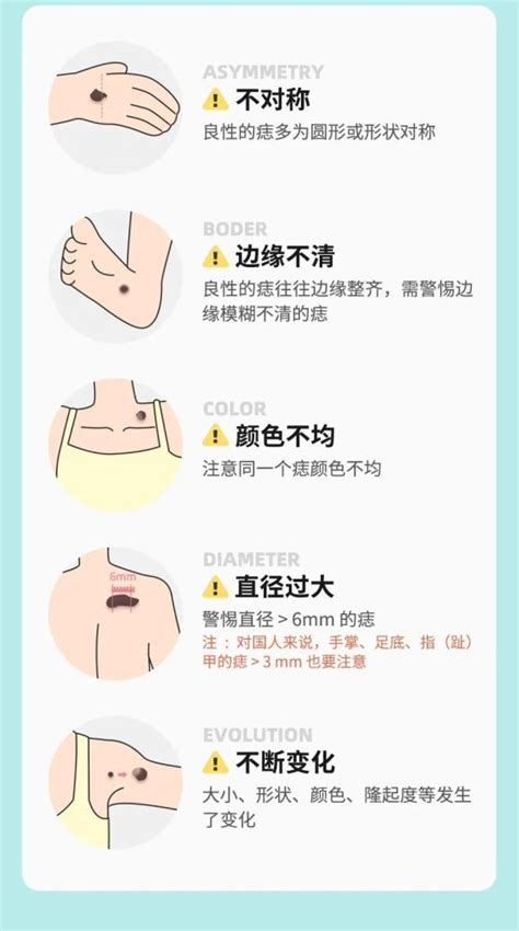 腋下旁邊有痣|痣也可能会癌变！长在 3 个地方要注意